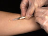 Learn how to evaluate people for latent TB infection with the Mantoux tuberculin skin test.  This podcast includes sections on administering and reading the Mantoux tuberculin skin test, the standard method for detecting latent TB infection since the 1930s.