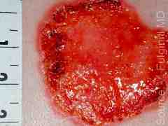 Example of progressive vaccinia lesions in a child with T-cell deficiency