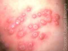 Typical umbilicated papules of vaccinia