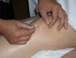 Acupuncture on a knee