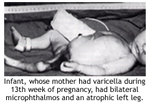 Infant, whose mother had varicella during 13th week of pregnancy, had bilateral microphthalmos and an atrophic left leg.