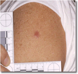 This image has an area of erythema but no central lesion and is classified as a “non-take.”
