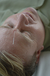 An acupuncture needle in a man's forehead. © Bob Stockfield