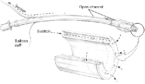 diagram of mucus slurper device