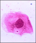 A photomicrograph of Neisseria meningitidis recovered from the urethra of an asymptomatic male; Magnified 1125X (N. meningitidis is responsible for causing “meningococcal” meningitis. This bacterium is not normal flora, but a pathogenic organism that may be present in a large percentage of the population without causing disease).
