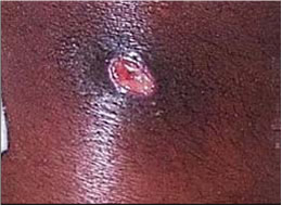 image of open sore with staph infection