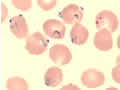 Plasmodium falciparum parasites in a thin blood smeararasite 