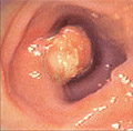 Photo of Polyp