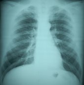 Normal Chest Radiograph