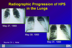 Slide 17: Radiographic Progression of HPS in the Lungs