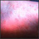Early (macular) rash on sole of foot in patient with Rocky Mountain spotted fever