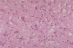 Tissue slide shows sponge-like lesions in the brain tissue of a classic CJD patient.
