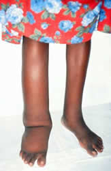 Patient with lymphedema of the leg