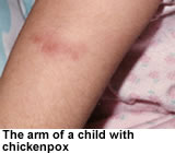 The arm of a child with chickenpox