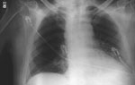 Figure 1. Initial chest X-ray (Case 1) showing prominent superior mediastinum and possible small left pleural effusion.