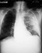 Figure 3. Chest X-ray (Case 2) showing diffuse consolidation consistent with pneumonia throughout the left lung. There is no evidence of mediastinal widening.