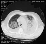 Figure 4. Computed tomography of chest (Case 2) showing bilateral pulmonary consolidation and pleural effusions.
