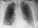 Figure 5. Chest X-ray (Case 7) showing mediastinal widening and a small left pleural effusion.