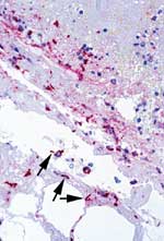 Figure 7C. Lymph node from same case shown in B, showing abundant Bacillus anthracis granular antigen staining inside mononuclear inflammatory cells and bacilli (arrows) in the subcapsular hemorrhagic area. (Immunohistochemical assay with a mouse monoclonal anti-B. anthracis cell wall antibody and detection with alkaline phosphatase and naphthol fast red, original magnification 100X)