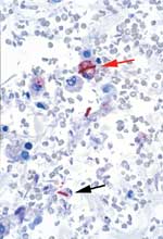 Figure 7D. Lung tissue from a fatal case showing Bacillus anthracis granular antigen staining inside a perihilar macrophage (red arrow) and intra- and extracellular bacilli (black arrow). (Immunohistochemical assay with a mouse monoclonal anti-B. anthracis cell-wall antibody and detection with alkaline phosphatase and naphthol fast red, original magnification 100X)