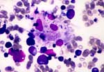 Figure. Bone marrow aspirate showing phagocytosis of neutrophil, nucleated erythrocyte, and platelets by benign histiocytes (Wright stain, x400).