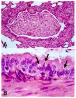 Figure 1. Lung lesions in an African wild dog with canine distemper. Hematoxylin and eosin staining. A. Bronchiole occluded by inflammatory cells and cell debris. B. Detail of A, showing multiple eosinophilic intracytoplasmic viral inclusions (arrows) in bronchiolar epithelium.
