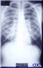 Marked interstitial edema with hilar indistinctness, Kerley B lines, in HPS.