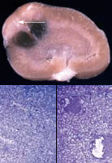 photo collage showing an Eker rat's kidney with a tumor and images comparing normal and cancerous kidney tissue