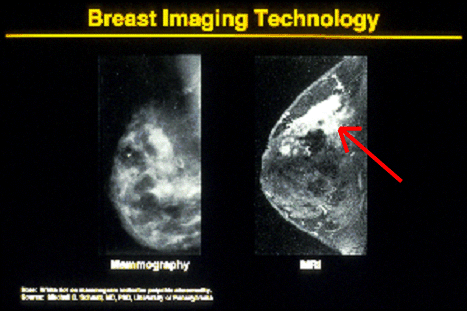 picture of two mammograms.