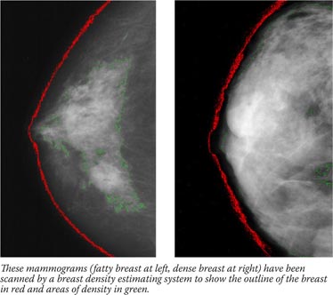 These mammograms (fatty breast at left, dense breast at right) have been scanned by a breast density estimating system to show the outline of the breast in red and areas of density in green.