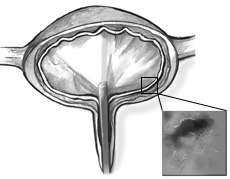 Ilustración de la sección transversal de una vejiga con un cistoscopio visible en la uretra. Un recuadro muestra una sección engrandada de la pared de la vejiga interior donde visiblemente se enseña sangrado.