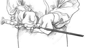 Ilustración de un dibujo lineal de un cistoscopio en manos de un cirujano.