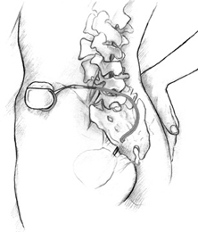 Ilustración anatómica que muestra el implante de un aparato de estimulación nerviosa en la parte baja del abdomen de una paciente mujer.