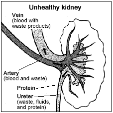 Drawing of a kidney cross section, with parts and functions labeled, showing an unhealthy kidney.
