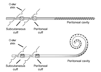 Illustration of two peritoneal catheters.
