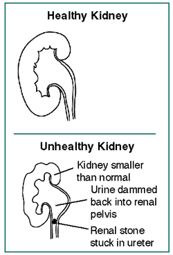 Illustration of a healthy kidney and one affected by hydronephrosis
