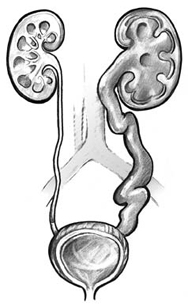 Two drawings showing different problems in the urinary tract. The left drawing shows a kidney that is swollen because the ureter is closed, preventing urine from leaving the kidney. The right drawing shows urine flowing backward from the bladder to the ureter and kidney. The affected ureter and kidney are swollen.