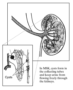 Drawing of a medullary sponge kidney. The large part of the kidney appears to be porous, like a sponge. An inset shows a microscopic view of a nephron with cysts growing on the tubule. Labels point to the cysts.