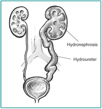 Front-view diagram of urinary tract with blockage.  One ureter and kidney are swollen.  The swollen ureter is labeled 'hydroureter.' The swollen kidney is labeled 'hydronephrosis.'