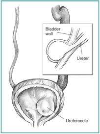 Front-view diagram of a bladder and ureter illustrating a ureterocele.  The ureter is swollen.  The bladder is shown in cross-section to reveal that the ureter extends into the interior of the bladder.  An inset shows a side-view cross-section of the ureter bulging inside the bladder wall.