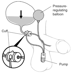 An artificial sphincter keeps the urethra closed with three parts: a cuff that fits around the urethra, a pump that is placed in the scrotum, and a pressure-regulating balloon that is placed in the abdomen.