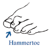 Drawing of a foot with an arrow pointing to a hammertoe.