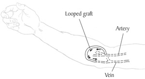 Illustration of a looped graft.