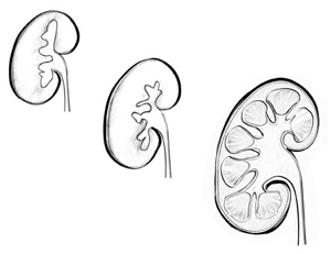 Drawing of three kidneys that represent different stages of development. At the upper left, the smallest kidney is connected to a ureter with only a couple of branches into the kidney. In the middle, a slightly larger kidney is connected to a ureter with a few more branches into the kidney. In the lower right, a fully developed kidney has urine-collecting branches throughout the kidney.