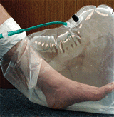 photo of patient's foot enclosed in an oxygen-filled bag