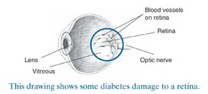 Picture of eye showing some diabetes damage.