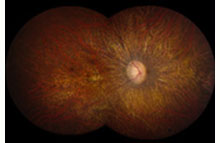 Retina photo of a patient with Leber congenital amaurosis