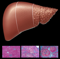 Conference artwork showing a liver and cross-sectional slides of hepatic cellular changes.