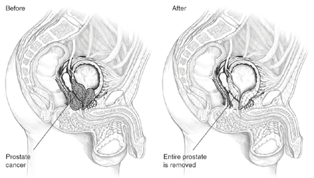 Before and after illustrations show the urinary system before prostate cancer is treated and after the entire prostate is removed.