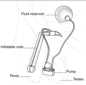 Drawing of inflatable penile implant